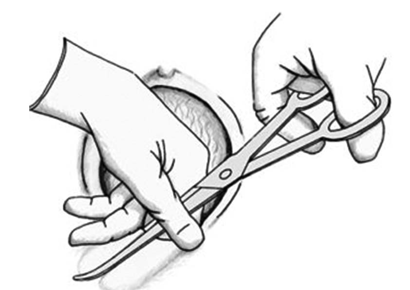 Penjagaan Luka Episiotomi dan Kekoyakan (Tear)