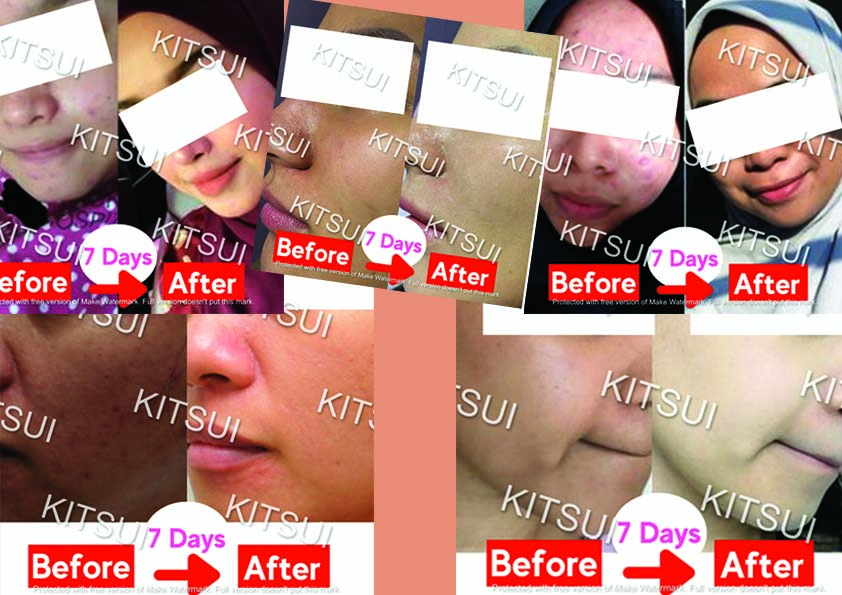 Kitsui White Berries BB Beaute Untuk Cantik dan Kitsui Fedloss Fibre D’Tox Untuk Masalah Pencernaan